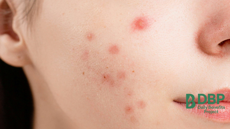 Close-up of acne breakout on woman’s cheek Face with multiple red acne spots and inflammation